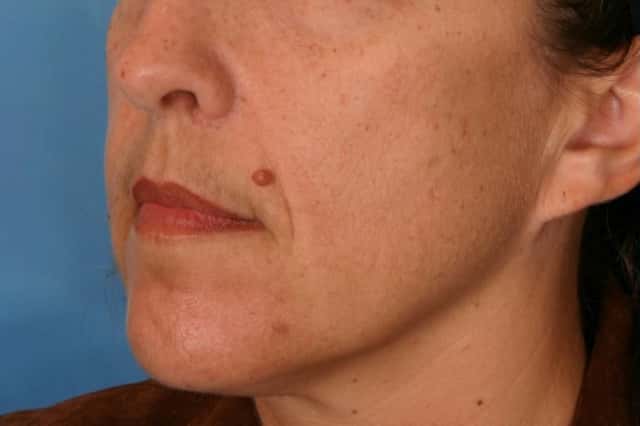Radiesse® Before & After Case 61 before