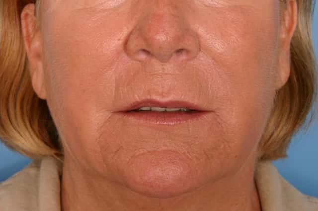 Radiesse® Before & After Case 80 after