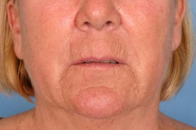 Radiesse® Before & After Case 80 before