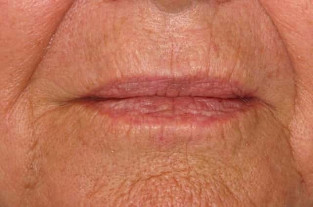 Radiesse® Before & After Case 81 after