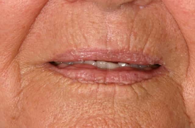Radiesse® Before & After Case 81 before