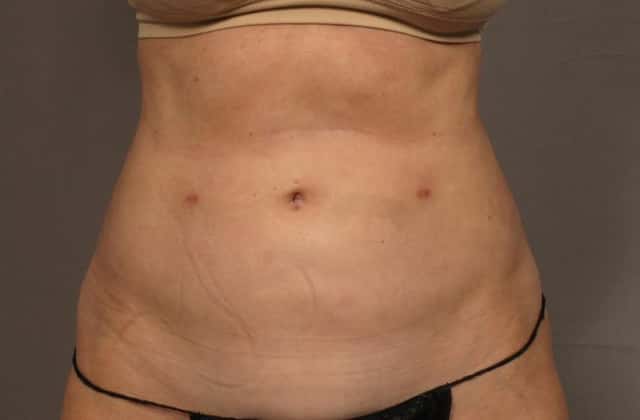 Frontal View of 59 year old Woman 3 Weeks After Renuvion and Liposuction of the Tummy