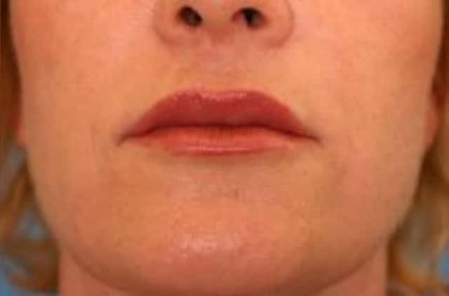 Restylane® Before & After Case 13 after