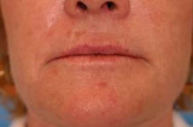 Restylane® Before & After Case 13 before