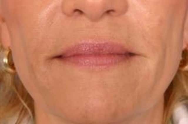 Restylane® Before & After Case 14 after