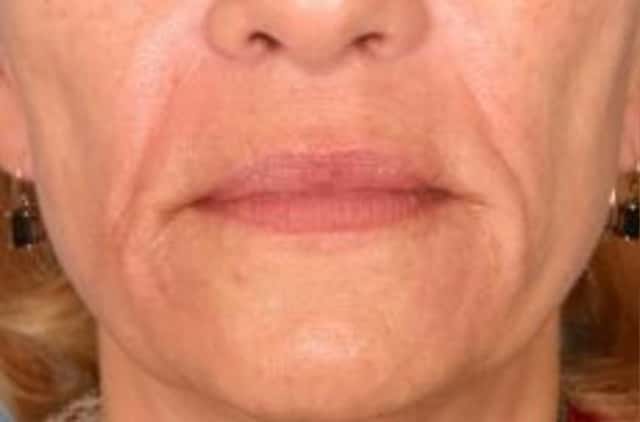 Restylane® Before & After Case 14 before