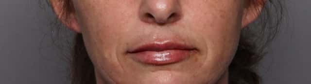 Frontal View Immediately After 1cc of Restylane Kysse Lip Filler