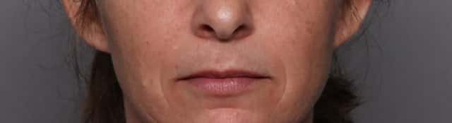 Frontal View Before 1cc of Restylane Kysse Lip Filler