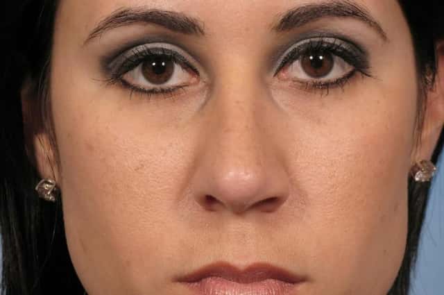 Rhinoplasty (Nose Reshaping) Before & After Case 127 after