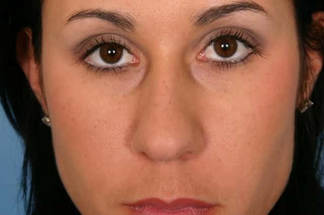 Rhinoplasty (Nose Reshaping) Before & After Case 127 before