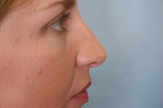 Rhinoplasty (Nose Reshaping) Before & After Case 128 before