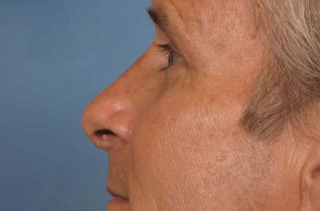Rhinoplasty (Nose Reshaping) Before & After Case 129 after