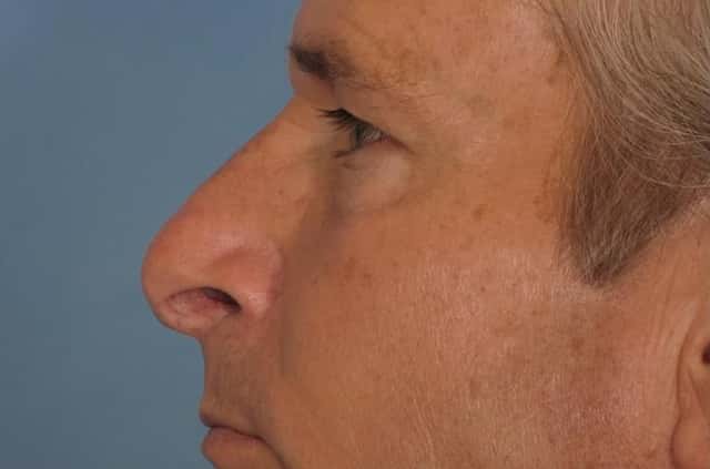 Rhinoplasty (Nose Reshaping) Before & After Case 129 before