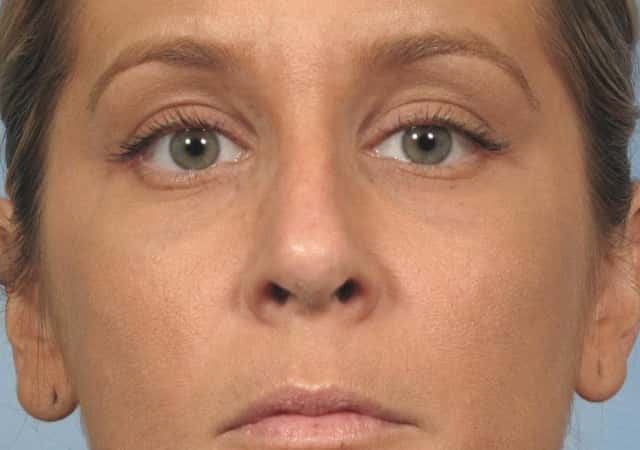Rhinoplasty (Nose Reshaping) Before & After Case 134 after
