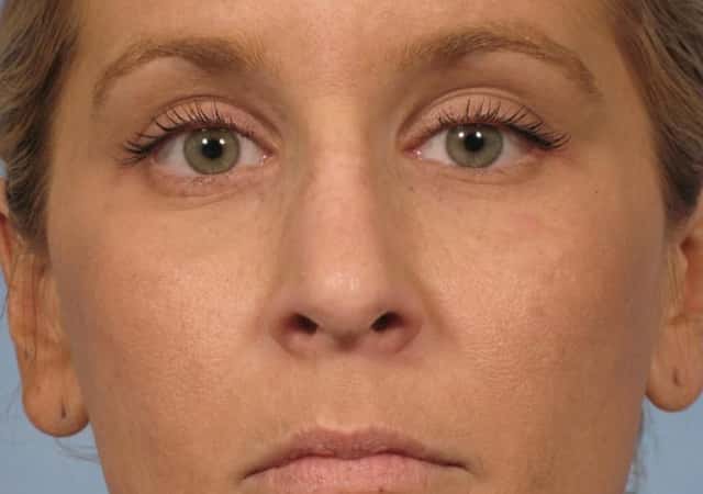 Rhinoplasty (Nose Reshaping) Before & After Case 134 before
