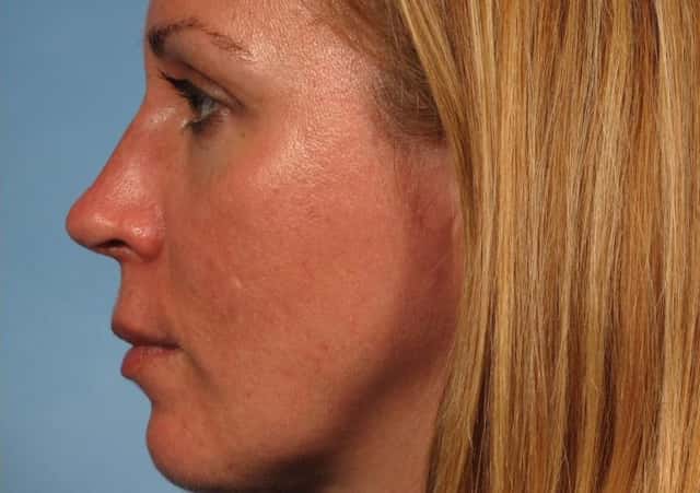 Rhinoplasty (Nose Reshaping) Before & After Case 140 after