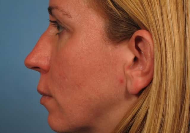 Rhinoplasty (Nose Reshaping) Before & After Case 140 before