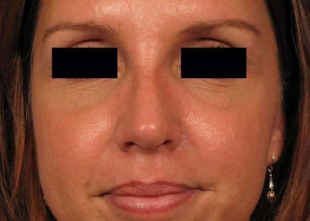Rhinoplasty (Nose Reshaping) Before & After Case 141 after