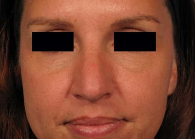 Rhinoplasty (Nose Reshaping) Before & After Case 141 before