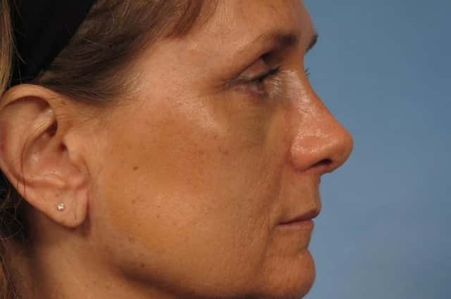 Rhinoplasty (Nose Reshaping) Before & After Case 145 after