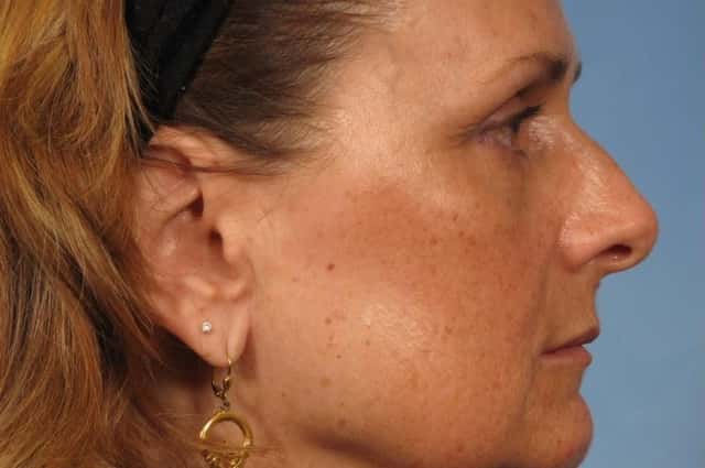 Rhinoplasty (Nose Reshaping) Before & After Case 145 before