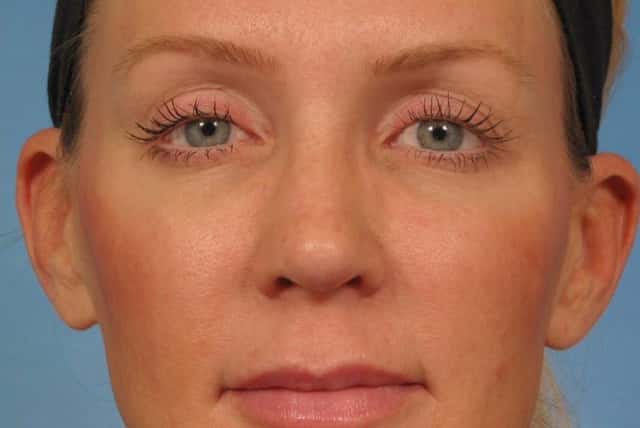 Rhinoplasty (Nose Reshaping) Before & After Case 152 after