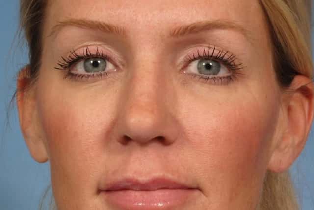 Rhinoplasty (Nose Reshaping) Before & After Case 152 before