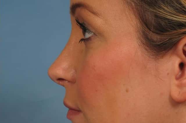 Rhinoplasty (Nose Reshaping) Before & After Case 219 after