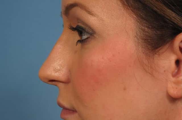 Rhinoplasty (Nose Reshaping) Before & After Case 219 before