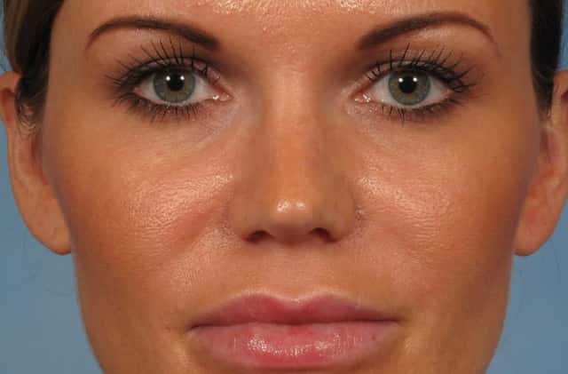 Rhinoplasty (Nose Reshaping) Before & After Case 221 after