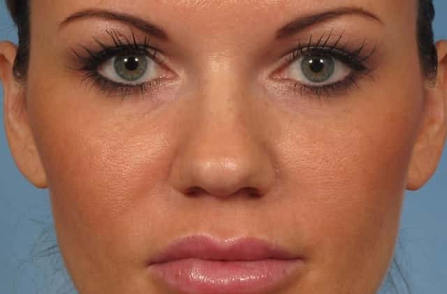 Rhinoplasty (Nose Reshaping) Before & After Case 221 before