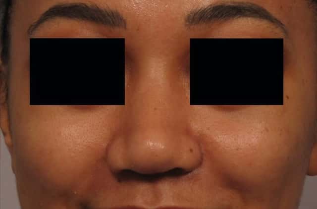 3 Month Post op frontal view of Female Rhinoplasty Patient
