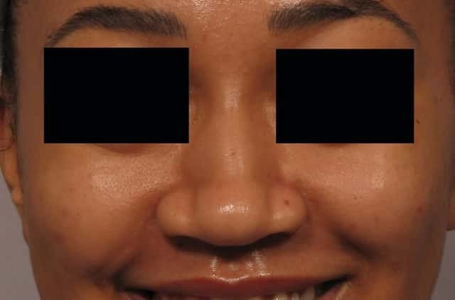 Pre op frontal view of Female Rhinoplasty Patient