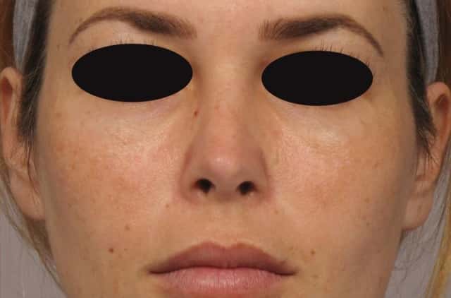 1 Year Post-op Frontal view of Rhinoplasty (Nose Reshaping) by Dr. Kent Hasen