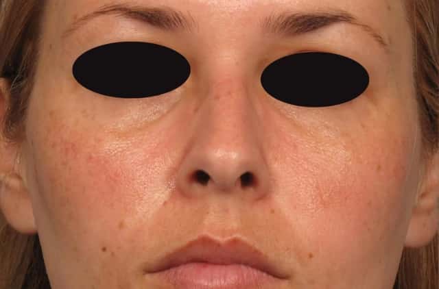 Pre-op Frontal view of Rhinoplasty (Nose Reshaping) by Dr. Kent Hasen