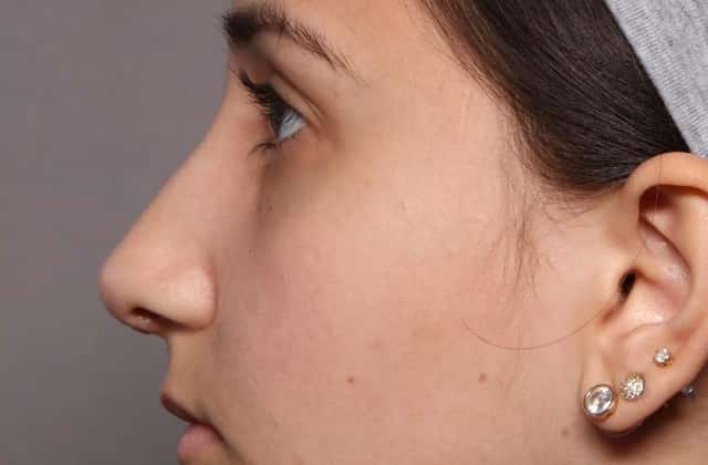 3-week Post-op Left Side View of Rhinoplasty Patient of Dr. Hasen in Naples Florida