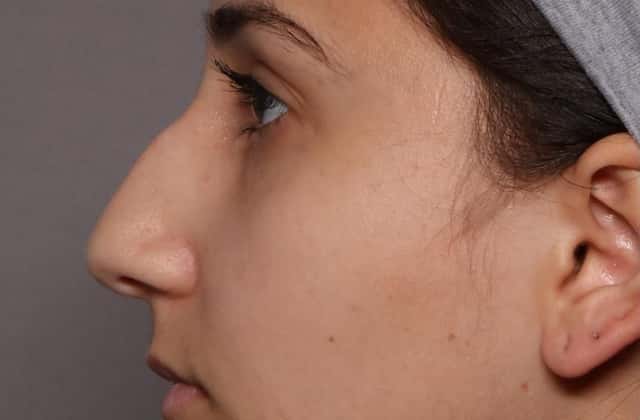 Pre-op Left Side View of Rhinoplasty Patient of Dr. Hasen in Naples Florida