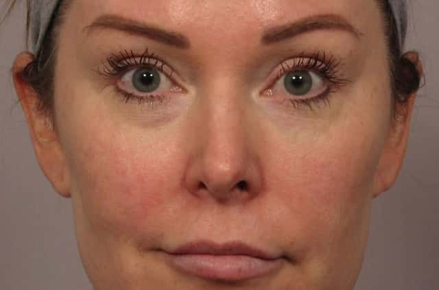 2 years Post-op Frontal View of Rhinoplasty or Nose Reshaping by Dr. Hasen