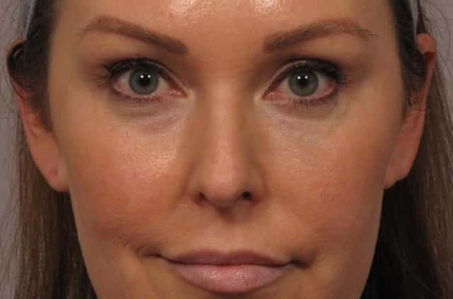 Pre-op Frontal View of Rhinoplasty or Nose Reshaping by Dr. Hasen