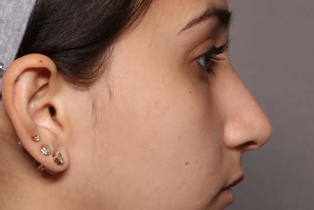 Rhinoplasty (Nose Reshaping) Before and After Photo, Right Side View, 3 Months Post