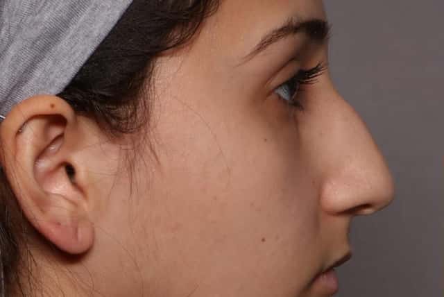 Rhinoplasty (Nose Reshaping) Before and After Photo, Right Side View, Pre