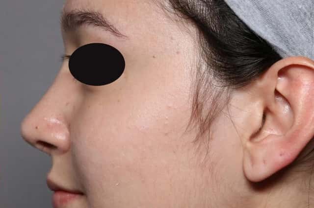 Rhinoplasty Left Side View, 3 Months Post