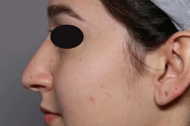 Rhinoplasty Left Side View, Pre