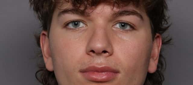 Rhinoplasty Frontal View 1 Month Post Op