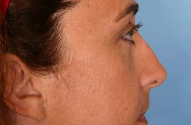 Rhinoplasty (Nose Reshaping) Before & After Case 62 after