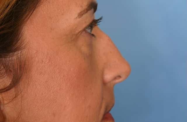 Rhinoplasty (Nose Reshaping) Before & After Case 62 before