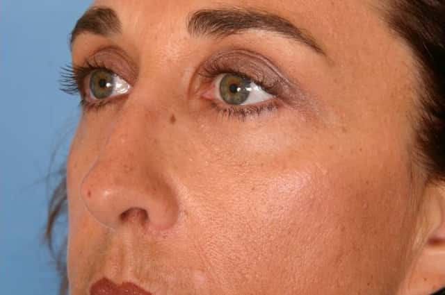 Rhinoplasty (Nose Reshaping) Before & After Case 62 after