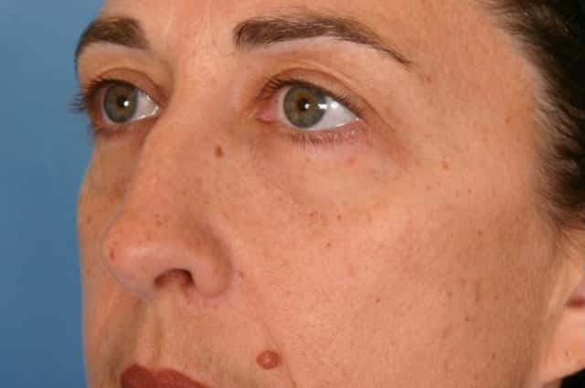 Rhinoplasty (Nose Reshaping) Before & After Case 62 before