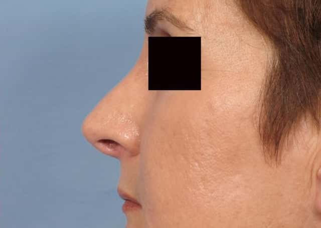 Rhinoplasty (Nose Reshaping) Before & After Case 78 after
