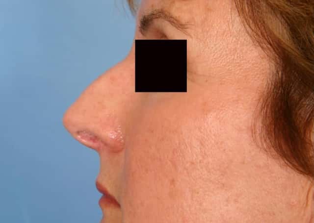 Rhinoplasty (Nose Reshaping) Before & After Case 78 before